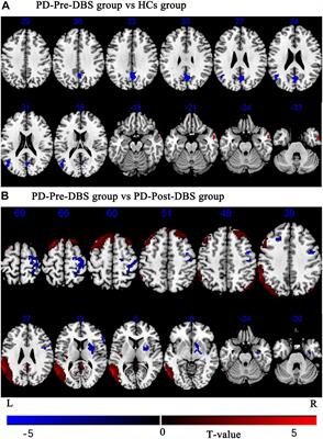 Altered Spontaneous Neural Activity and Functional Connectivity in Parkinson’s Disease With Subthalamic Microlesion